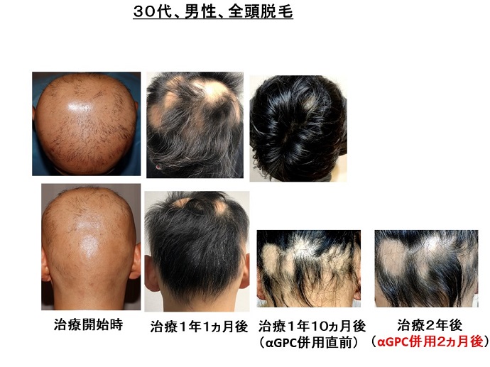 円形脱毛症　病院